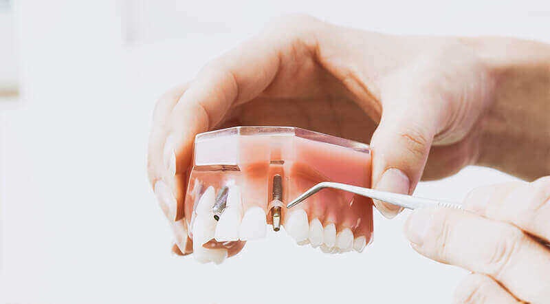 Dental implants - Bonavista Dental Centre, Ottawa